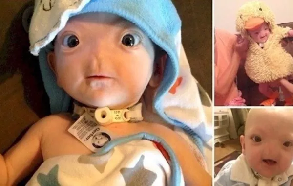 بالصور: طفل ولد بلا أنف يتحول إلى نجم على «الفيس بوك»..