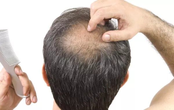 استشاري جلدية يوضح أسباب فشل عمليات زراعة الشعر