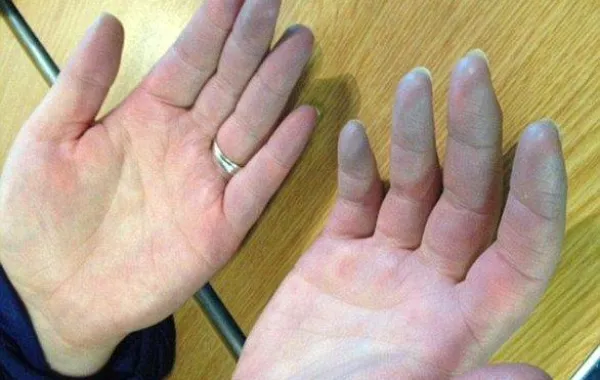 مذيعة شهيرة تصاب بمرض نادر في إصبع يدها