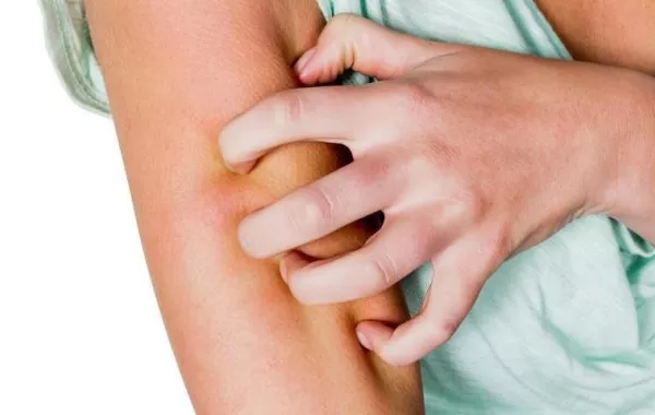 علاجات الجدات لـ لدغات الحشرات