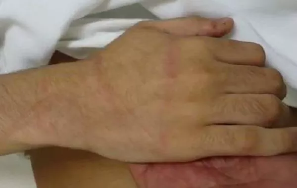 نزيل من ذوي الاحتياجات الخاصة يتعرض للتعنيف والحرق في القنفذة