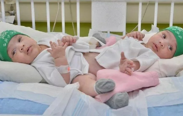 الآن تتم: عملية فصل توأم تنزاني في السعودية بأمر ملكي من خادم الحرمين الشريفين