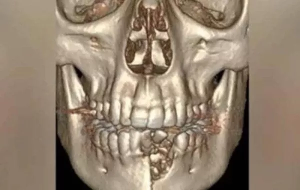تشوّه في وجه مراهق أميركي بسبب سيجارة إلكترونية