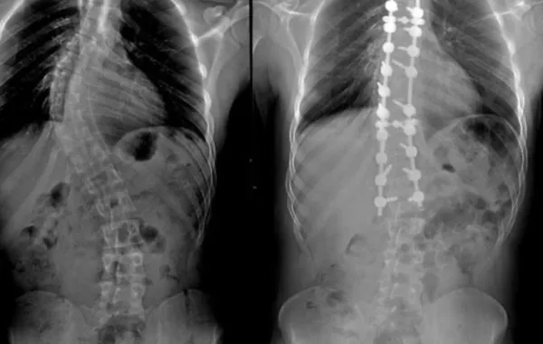 الدكتور الصالح: 20% من السعوديين يعانون من انزلاقات فقارية وهذا علاجها