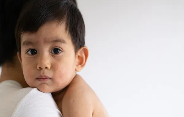 صورة لطفل يعاني من الحساسية