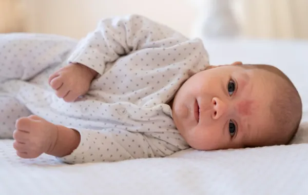 صورة لبقعة السلمون على جبهة المولود