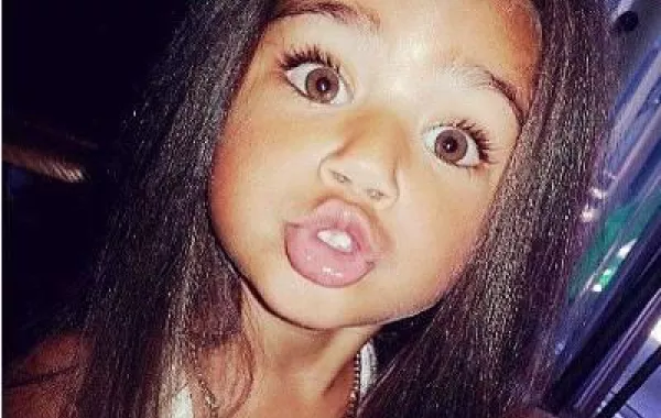 أطفال بشفاه البطة