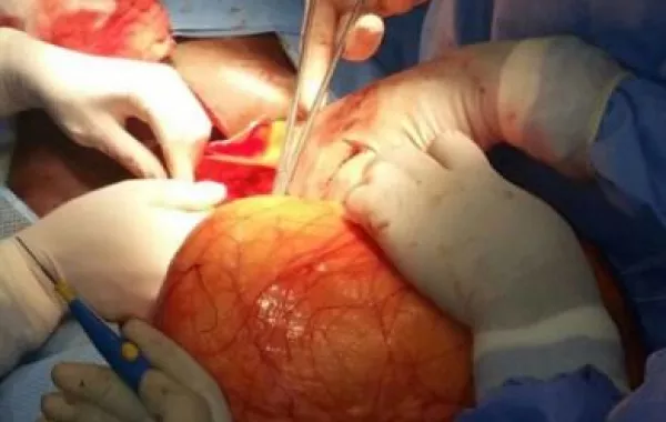 استئصال ورم يزن 6 كيلو جرامات لعشرينية في القطيف