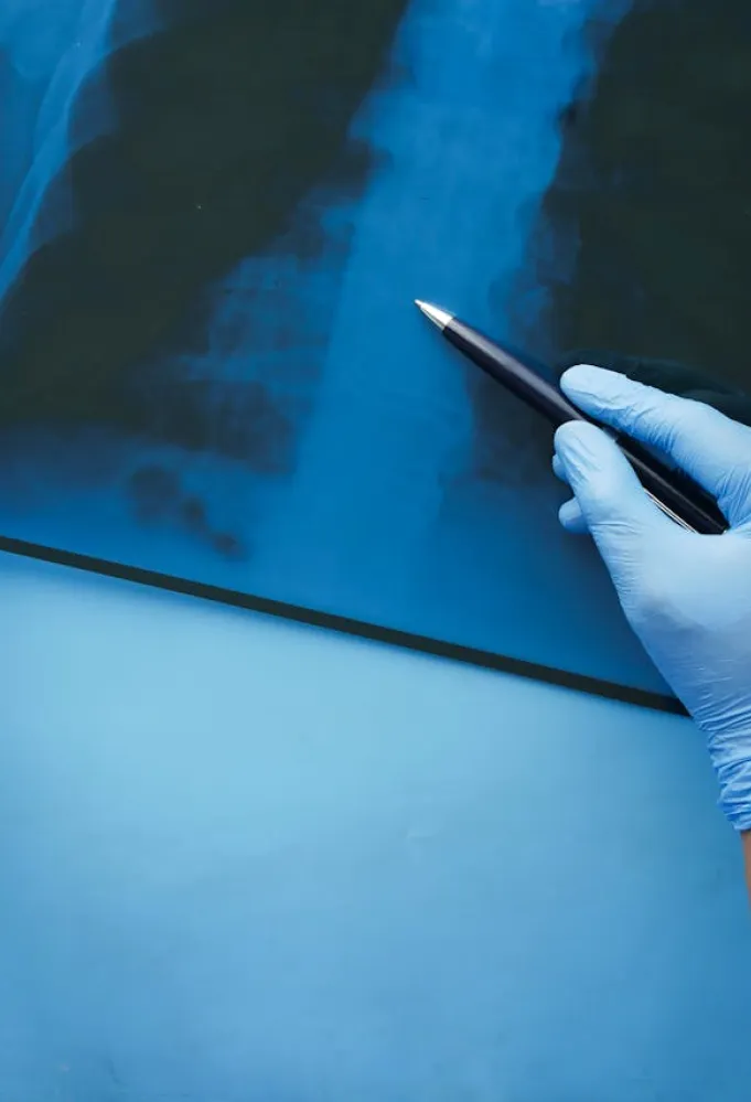 سرطان الرئة: النسب إلى ارتفاع بين النساء والسبب مع طبيب مختص لـ"سيّدتي"