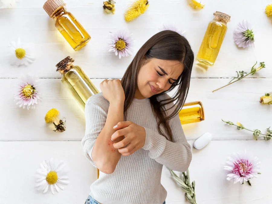 طرق تخفيف الأكزيما بمكوّنات منزلية